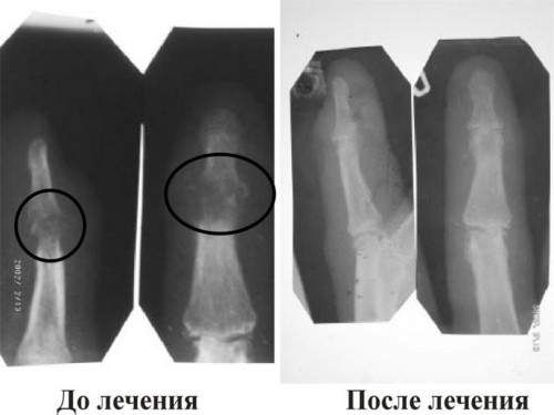 слабая костная мозоль после перелома что делать