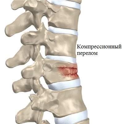 сможет ли человек ходить после перелома позвоночника