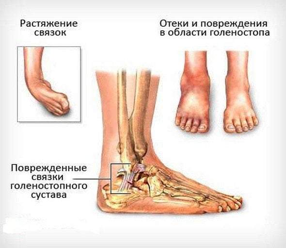 снять отек с лодыжки при растяжении связок народные средства