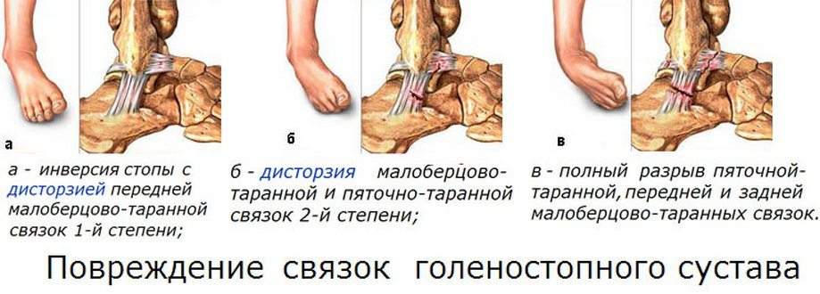 снять отек с лодыжки при растяжении связок народные средства