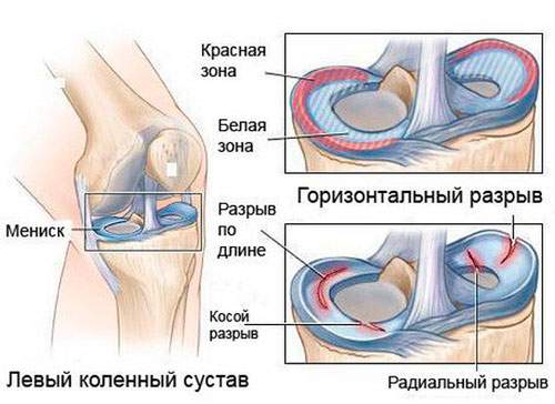 срм терапия восстановление после травм и переломов