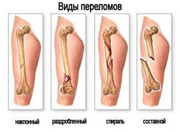 сроки образования костной мозоли при переломе лодыжки