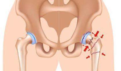 тазобедренный сустав перелом лечение в домашних условиях