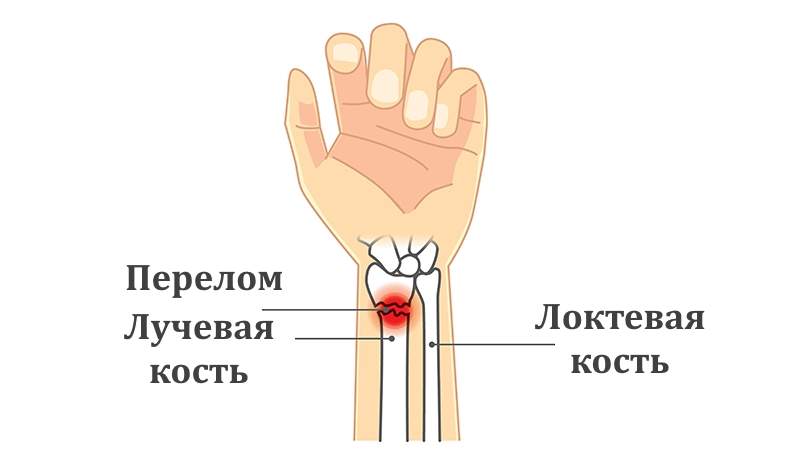 техника наложения гипса при переломе лучевой кости