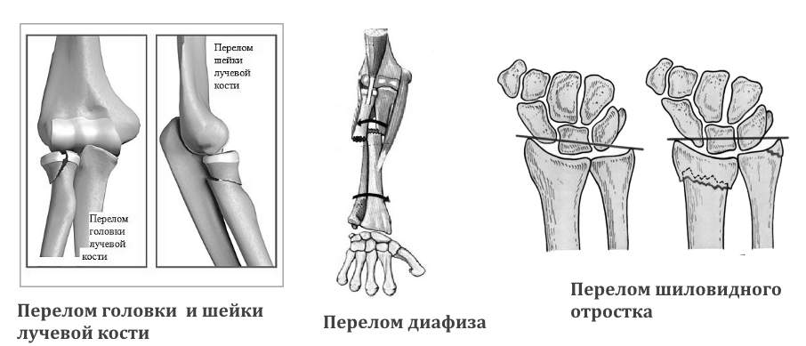 техника наложения гипса при переломе лучевой кости