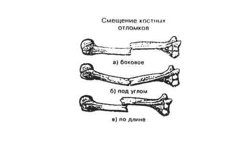 техника наложения гипса при переломе лучевой кости