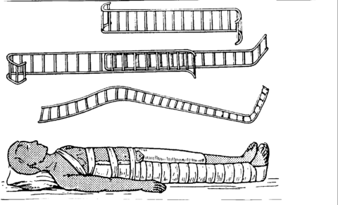 техника наложения шины крамера при переломе бедра