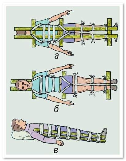 транспортировка при переломе верхних и нижних конечностей