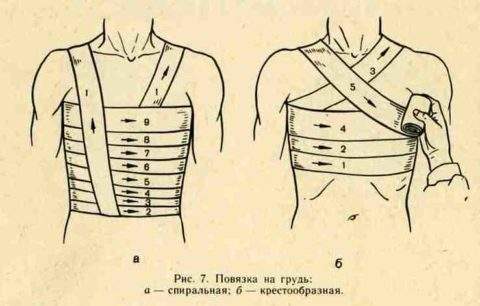 транспортная иммобилизация при переломах ребер и грудины