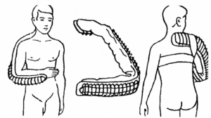 транспортная иммобилизация шиной крамера при переломе плеча