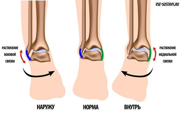 ушиб и растяжение связок правого голеностопного сустава что делать