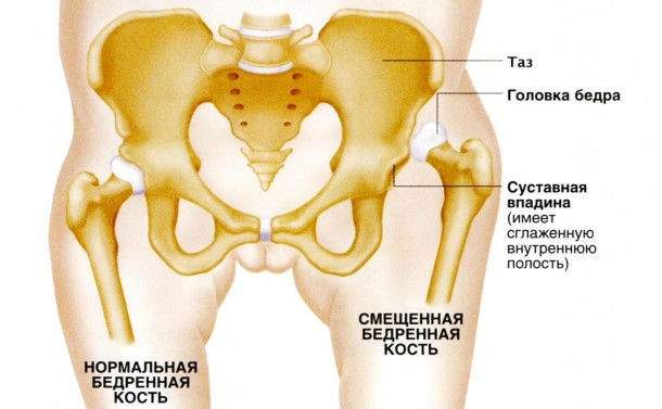 врожденный вывих бедра у детей симптомы и лечение