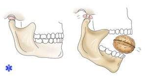 вывих челюсти при зевании лечение народными средствами