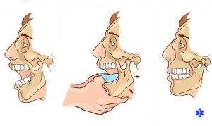 вывих челюсти при зевании лечение народными средствами