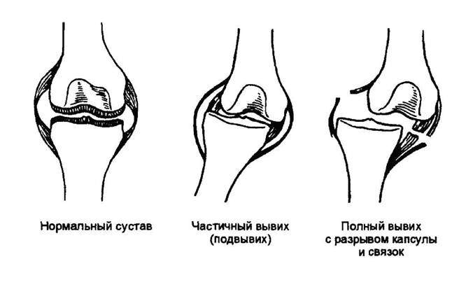 вывих это стойкое смещение суставных концов костей