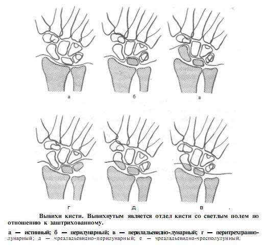вывих кисти руки лечение в домашних условиях