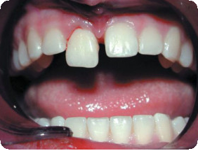 вывих переднего зуба у ребенка 3 года