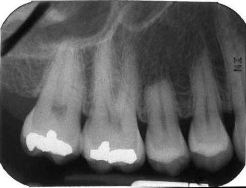 вывих переднего зуба у ребенка 3 года