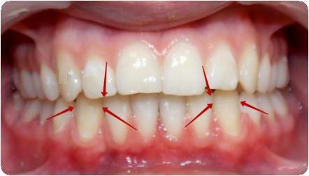 вывих зуба у ребенка в 2 года лечение