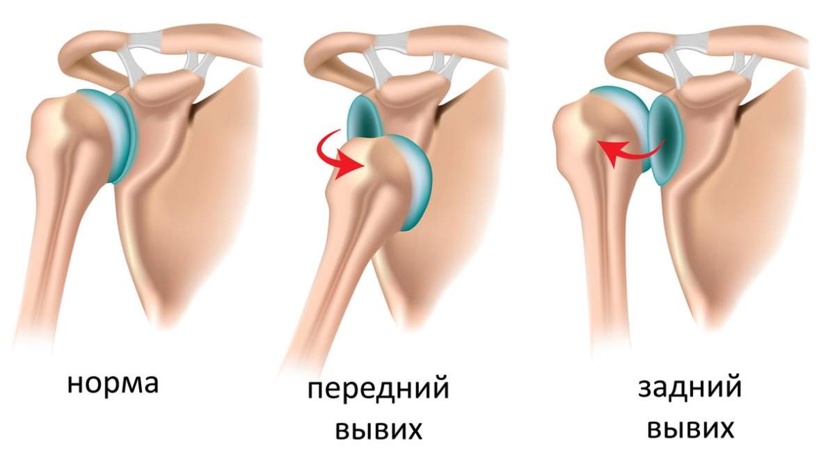 закрытые повреждения мягких тканей ушибы растяжения разрывы