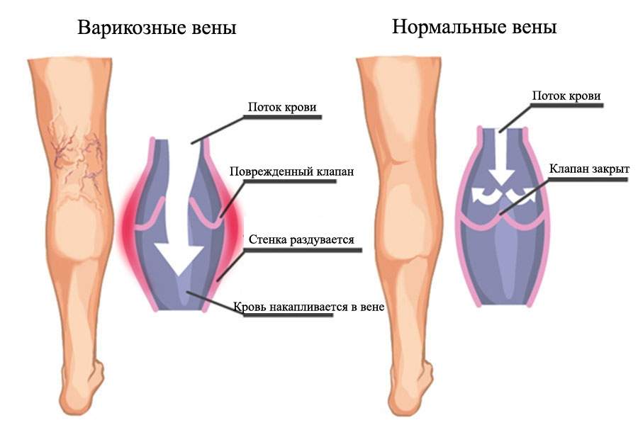 боль в ногах от колена до стопы отек