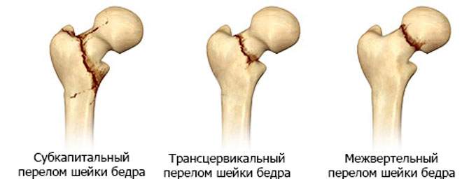 болит нога после операции перелом шейки бедра