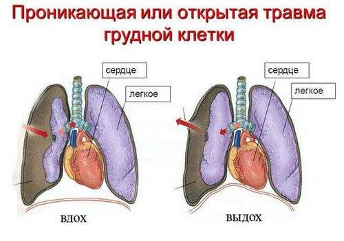 чем могут сопровождаться сотрясение или ушиб грудной клетки