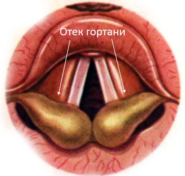 чем снять отек у ребенка при ларингите у