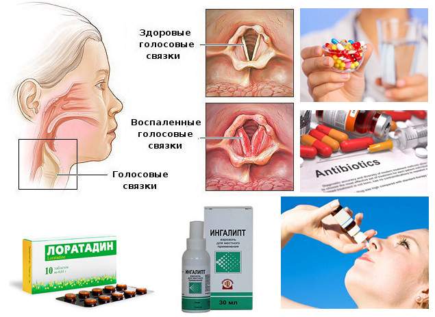 чем снять отек у ребенка при ларингите у