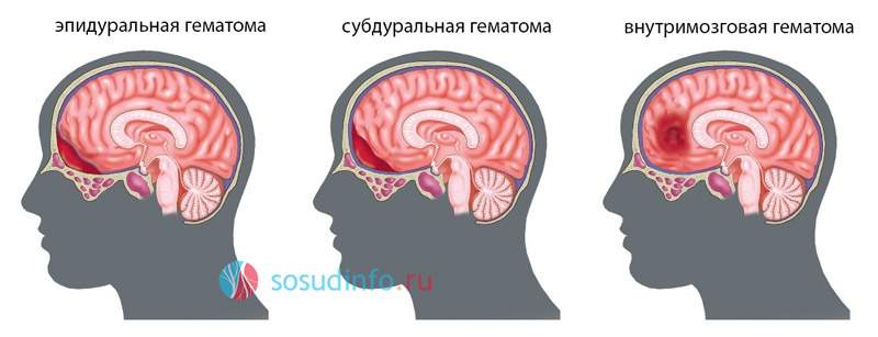 черепно мозговая травма с ушибом головного мозга