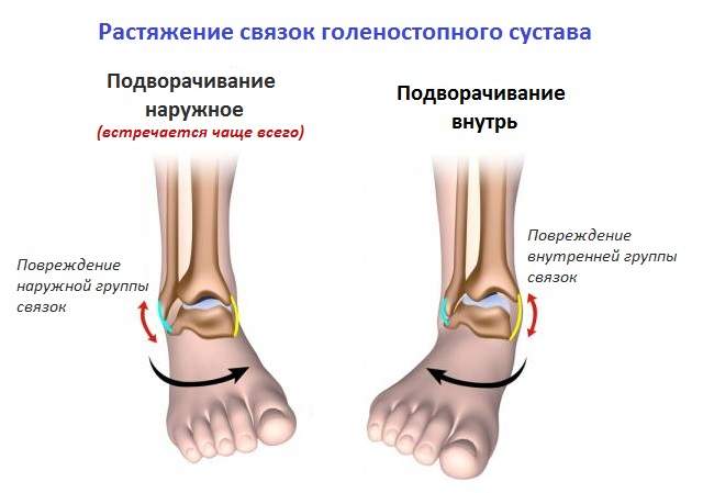 что делать при ушибе и растяжении лодыжки