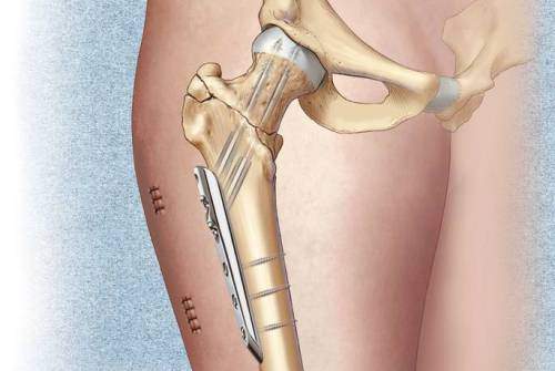что такое чрезвертельный перелом правой бедренной кости