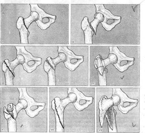что такое чрезвертельный перелом правой бедренной кости