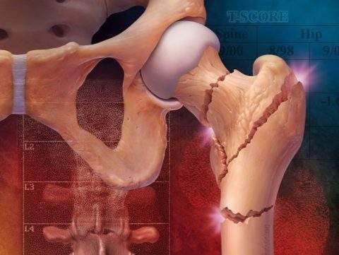 что такое чрезвертельный перелом правой бедренной кости