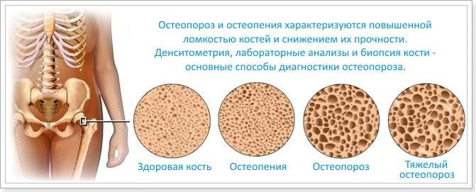 что такое компрессионный перелом позвоночника при остеопорозе