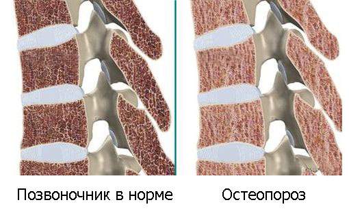 что такое компрессионный перелом позвоночника при остеопорозе