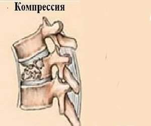 что такое компрессионный перелом шейного отдела позвоночника