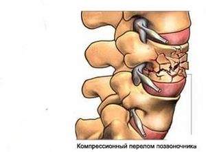 что такое компрессионный перелом шейного отдела позвоночника