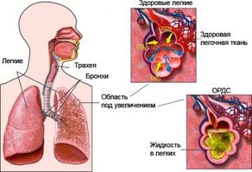 что такое отек легких и как он происходит