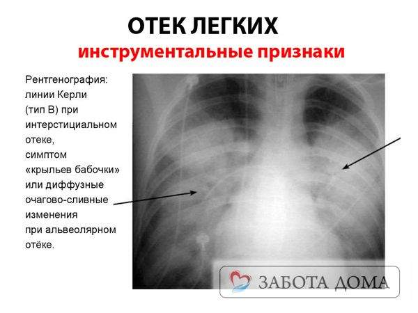 чтобы не было отека легких у лежачих больных