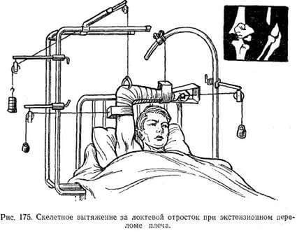 для чего нужна вытяжка при переломе ноги