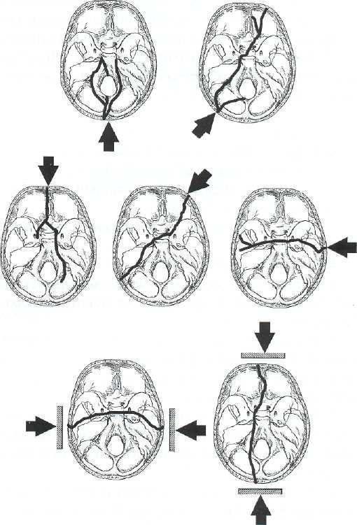 Перелом основания свода. Перелом основания черепа механизм. Перелом костей основания черепа. Перелом свода черепа, перелом основания черепа. Перелом основания черепа клиническая картина.