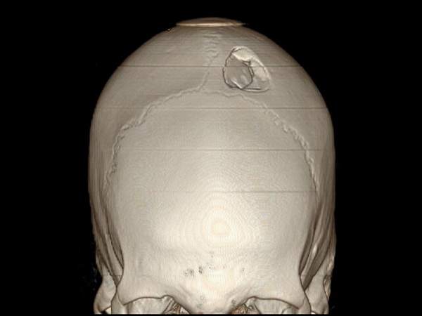 дырчатый перелом костей черепа образуется при воздействии