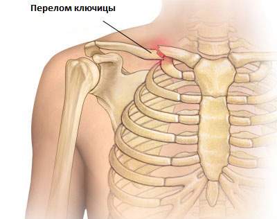 если у ребенка перелом ключицы дают больничный