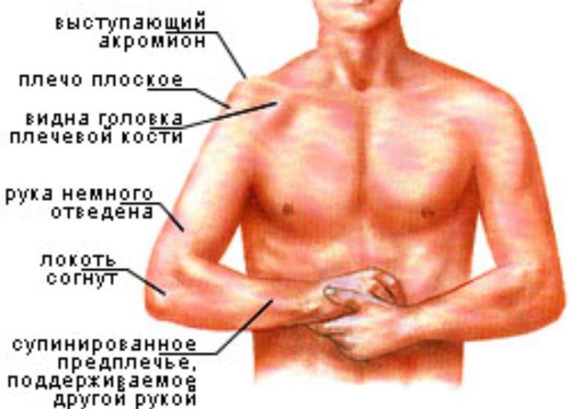 импрессионный перелом головки плечевой кости что это