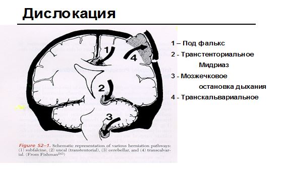 интенсивная терапия при сотрясении головного мозга ушибе