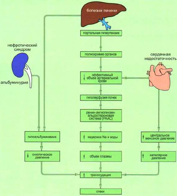 изобразите основные звенья патогенеза одного из видов отека сердечного