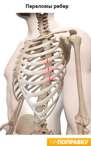 к какому врачу обращаться при ушибе ребра
