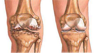 как лечить коленный сустав боль отек невозможно наступать