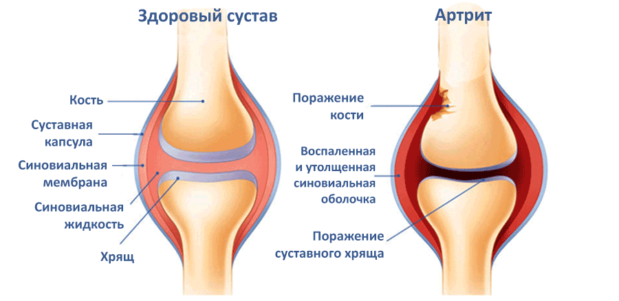 как лечить отек коленного сустава в домашних условиях